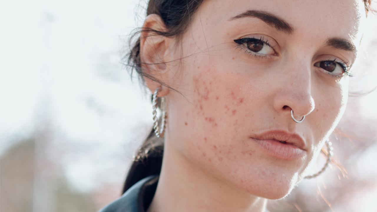 How to Deal with a Skin Allergy Outbreak Stat - FASHION Magazine